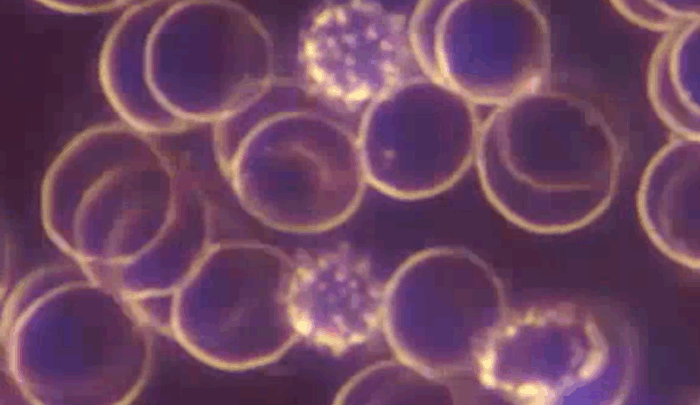 red blood cells with irregular localised surface projections