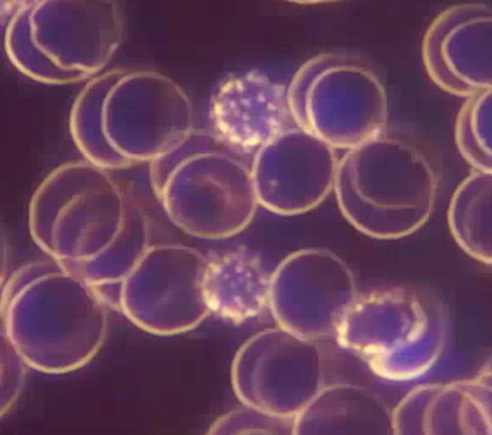 red blood cells with irregular localised surface projections