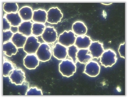 Poikilocytosis (Poikilocytes)