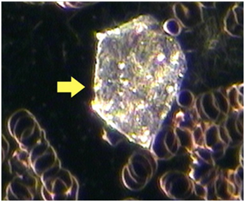 Cholesterol Crystals